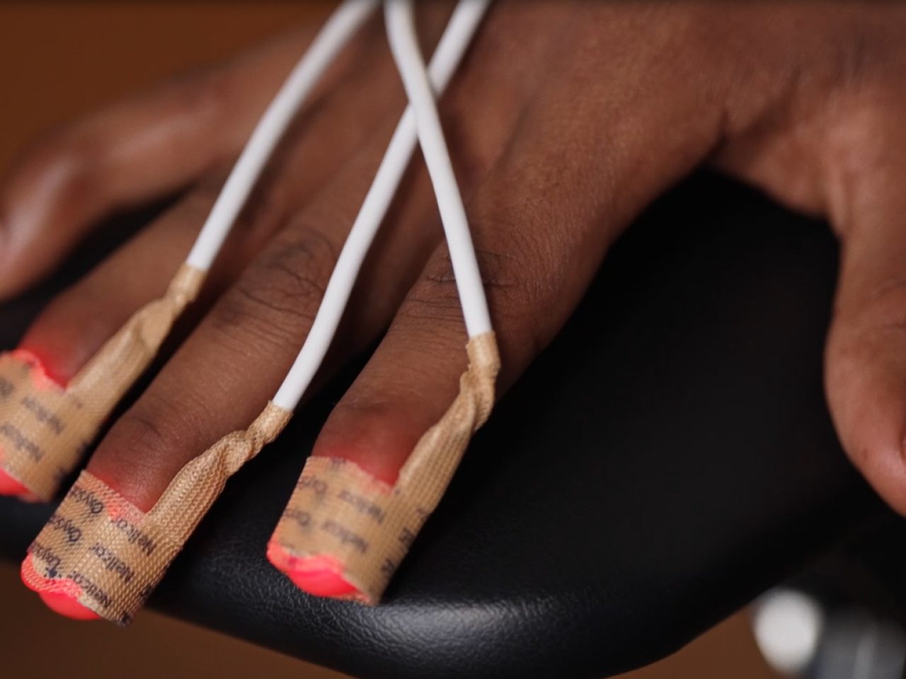 Image of a patient's hand connected to a Medtronic pulse oximeter