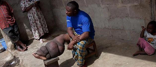 a person with LF rests their leg on a stool